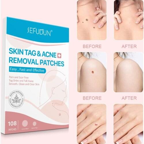 Skin Tag Remover Patch Ance Pimple Patch Plaster Acne Cream Anti-infection Quick Absorb Face Care 108 Patches
