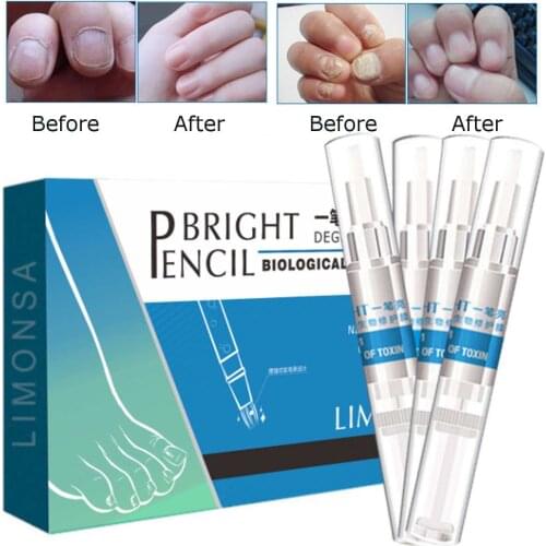4 Pcs/Set Fungal Nail Pen Effective Onychomycosis Paronychia Fungus Biological Repair Solution Nail Fungal Treatments 3ml/Pcs