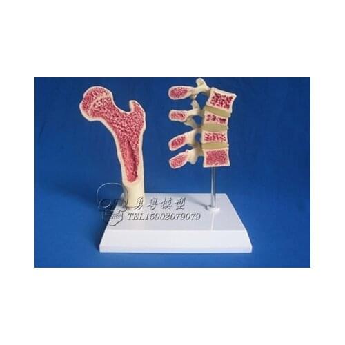 Human osteoporosis health and pathological Comparison model