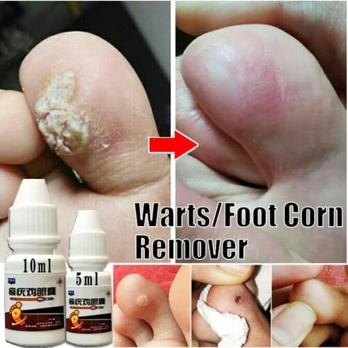 10ml/5ml Remover Foot Corn Care Cream Medical Plaster Treatment Warts Thorn Cream Corn of Removal foot Calluses Callosity Detox