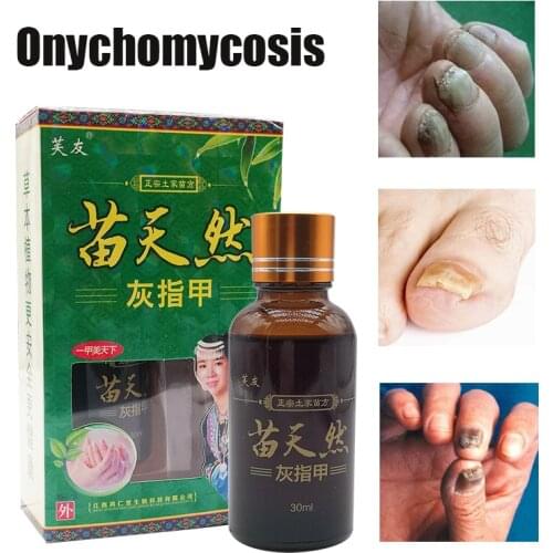 Chinese Medicine Ointment Nail Fungus Removal Gel Anti Infection Paronychia Treatment Onychomycosis Repair Essence Serum
