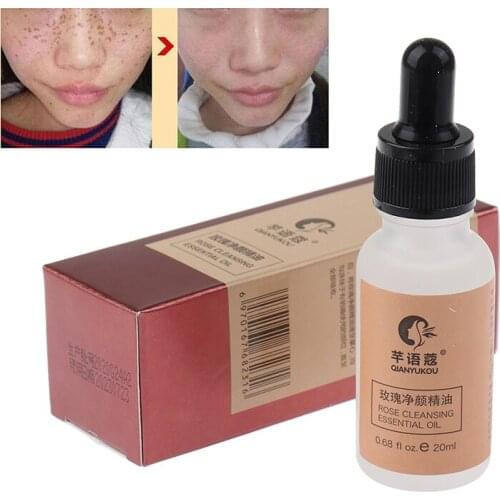 20ml rose essential oil for removing nevus and preventing scar Natural healthy skin removing mole repair essence