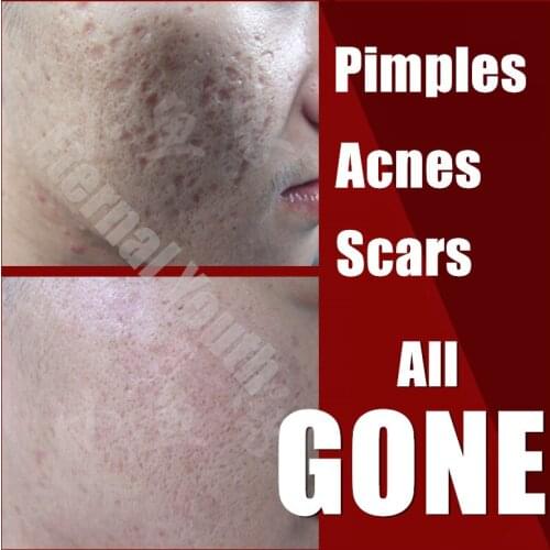 3 in 1 Acne Spot Pimple Treatment Natural Herbal Cream 3Days Pimples Removal Set Skin Care