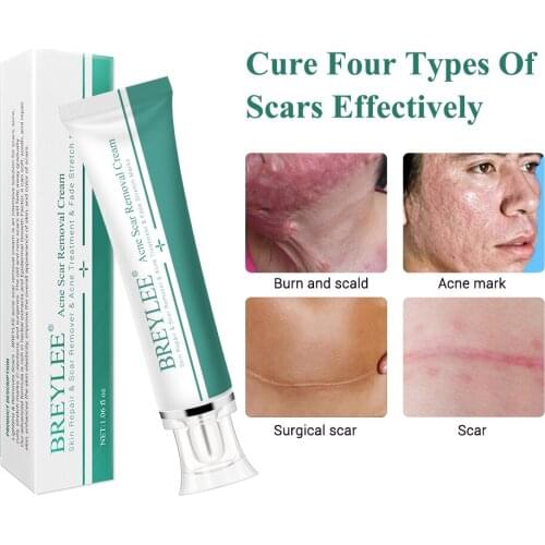 BREYLEE Acne Scar Removal Cream 30g Face Cream Skin Repair Skin Care Scar Acne Treatment Remove Stretch Marks Whitening Cream