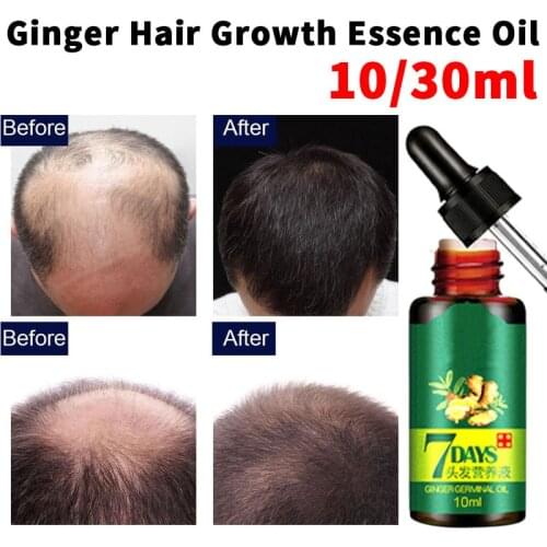 10ml Ginger Hair Growth Essence Oil Hair Loss Treatment Serum For Thicker Healthier Hair Men Women Repair Damaged Hair hot sale