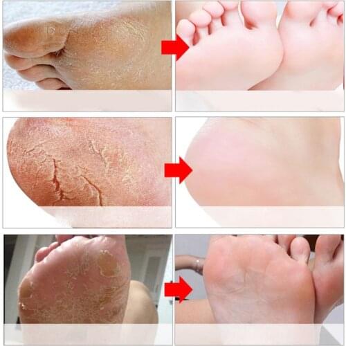 Exfoliating Foot Mask Pedicure Socks Remove Dead Skin Cuticles Moisturizing Tool 40JD
