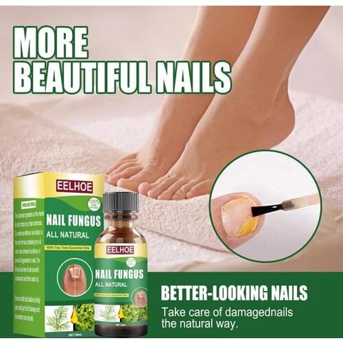 30ml Fungal Nail Treatments Essences Toe Care Repair Serum Foot Nail Fungus Removal Gel Foot Care Solution