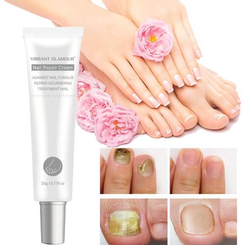 Nail Repair Cream Nail Fungus Treatment Onychomycosis Removal Anti Fungus Nail Toe Foot Repair Cream 20g