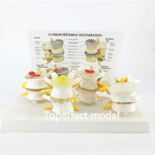 Medical Normal Lumbar Spine Lesion Combined Anatomical Model Intervertebral Disc Pain Teaching Skeletal Model