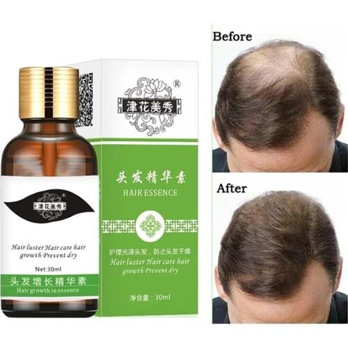 Fast Hair Growth Essence Hair Loss Products Hair Growth Fibras Cabelo Shampoo Cremes De Tratamento Para Cabelos Hair Care