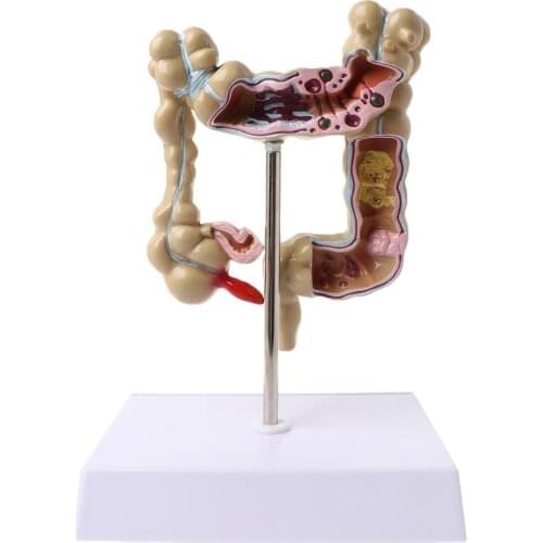 Human Colorectal Lesion Model Pathological Anatomy Colon Diseases Intestine Medical Teaching Learning Tool