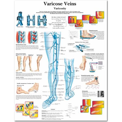 WANGART Varicose Veins Chart Poster Print Canvas Painting Wall Pictures for Medical Education Doctors Office Classroom