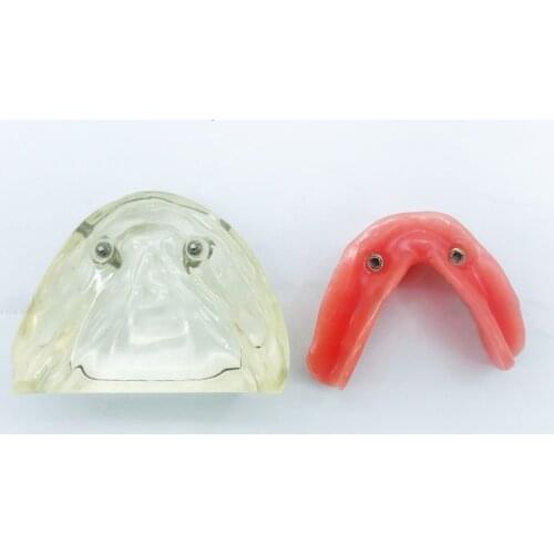 Dental Teeth Study Model with 2 Implant for Removable Interior Mandibular Tooth model