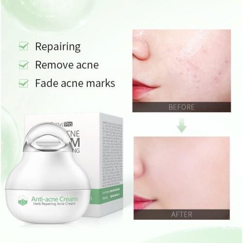 Anti-acne Cream Treatment Face Cream Blackhead Acne Repair Gel Oil Control Shrink Pores Scar Facial Skin Care Whitening TSLM2