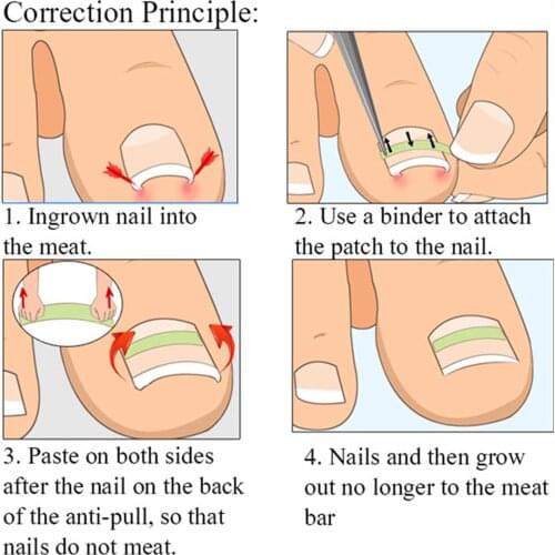 Ingrown Toenail Correction Tool Ingrown Toe Nail Pedicure Patch Straightening