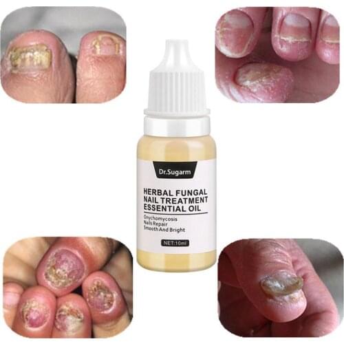 Nail repair solution treatment with files to remove toe nourishment fungus, nail and brighten nails R2H7