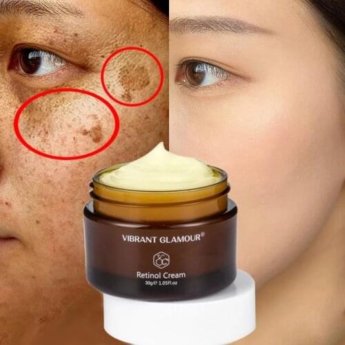 Effective Whitening Cream Retinol Removes Melasma Acne Spots Pigment Dark Spots Anti-Aging Wrinkle Moisturizing Skin Care