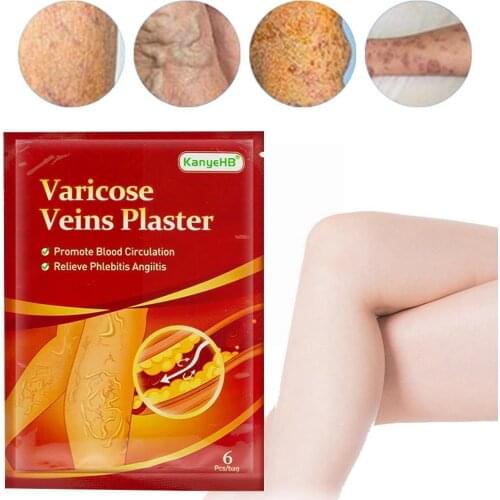 Varicose Veins Ointment Vasculitis Phlebitis Spider Soft Tissue Plaster Cream Angiitis Treat Plaster Medical Varicosity Swe U5E5