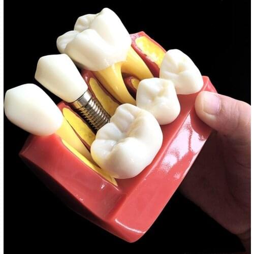 1 PC 4-times Implant Disease Teeth Model Oral Teaching Model Dental Pathology Model