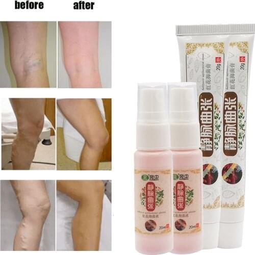 Chinese Natural Herbal Medicine for Varicose Veins Cream Vasculitis Inflammation Leg Massage Varicose ​Spray Varizes Ointment