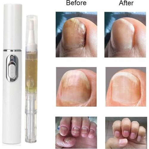 2 pcs/set Nail Toe Anti Fungal Treatment Pen Onychomycosis Paronychia Infection Biological Repair Serum Care Painless Foot Cream