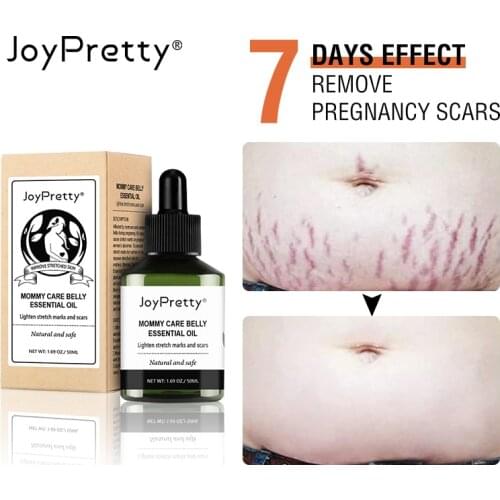 AUQUEST Remove Pregnancy Scars Acne oils Stretch Mark Treatment Maternity Repair Anti-Aging Anti-Winkle Firming Body Cream 50ml