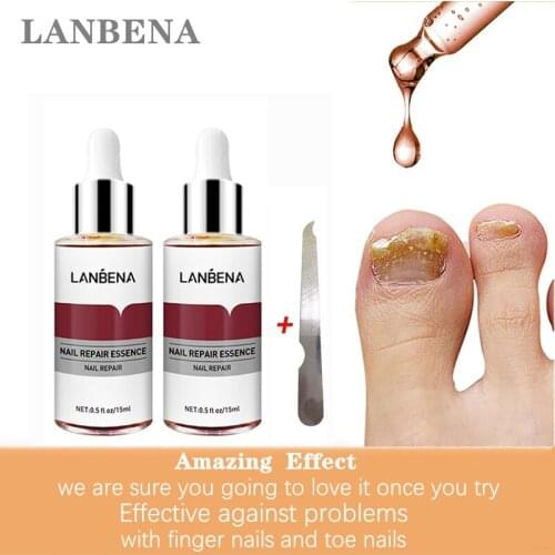 2PCS LANBENA Nail Care Essence Fungal Nail Repair Remove Onychomycosis Toes Athletes Foot Hand And Foot Skin Care