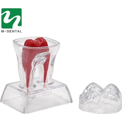 1PC Tooth Molar Model Separable Pathology Demonstration Model Transparent Dentistry Material Dentist Tools For Dental Lab