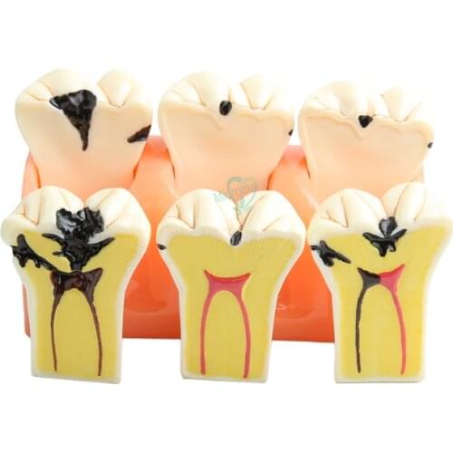 New Dental Teaching Model Patient Dissected Caries Model Oral Dental Tooth Model
