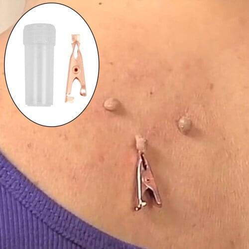 Small Skin Tag Removal Clips w/Smooth Jawed Skin Wart Tag Tattoo Smooth skin