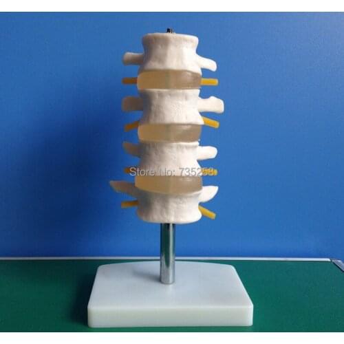 Lumbar Set(4 pcs) Lumbar spine model