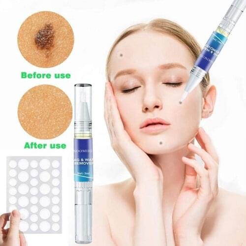 Genital Wart Treatment Papillomas Removal Of Warts Liquid Against Moles Remover Wart Removal Liuld Skin Tag Remover