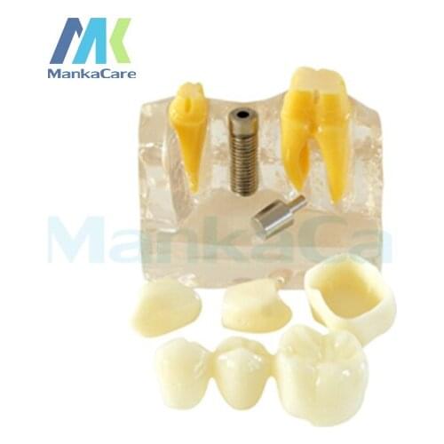 Manka Care - 4Times Implant Model/Made of high quality resin Oral Model Teeth Tooth Model