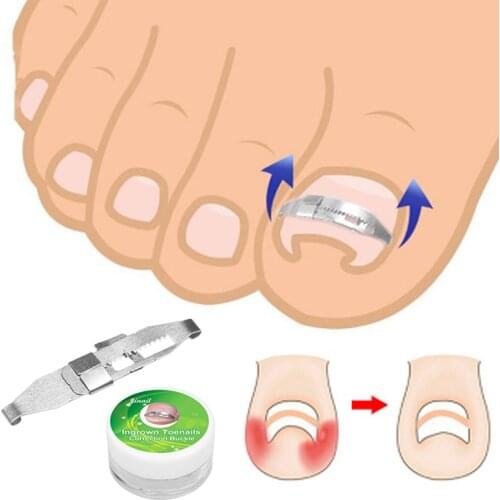 Ingrown Toenail Pedicure Tools Professional Recover Embed Toe Nail Treatment Paronychia Bunion Hallux Valgus Corrector Foot Care