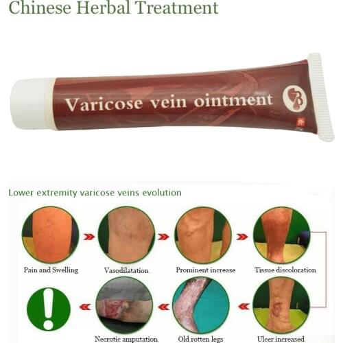 Varicose Veins Treatment Cream Ointment Vasculitis Phlebitis Spider Veins Pain Varicosity Angiitis Remedy Removal Herbal Cream