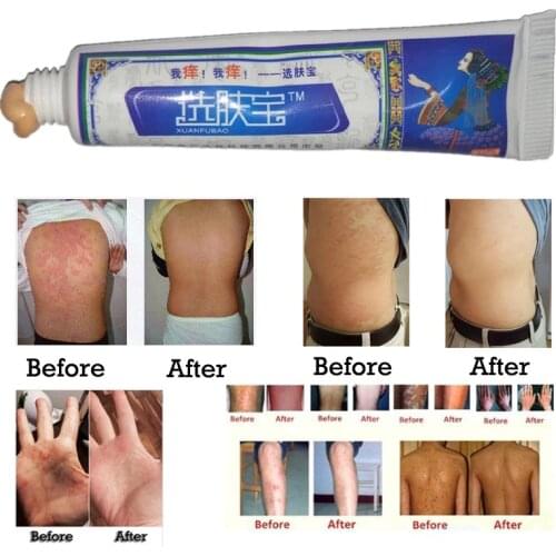 Treatment Psoriasis Eczema Itching Skin Care Herbal Body Cream Psoriasis Cream Dermatitis Itching Repair Eczematoid Ointment