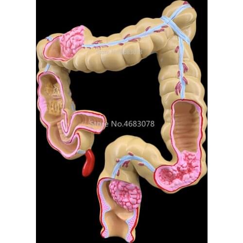Colorectal lesion model human colon large intestine pathological diseases model medical organizer anatomy 14x17x21cm