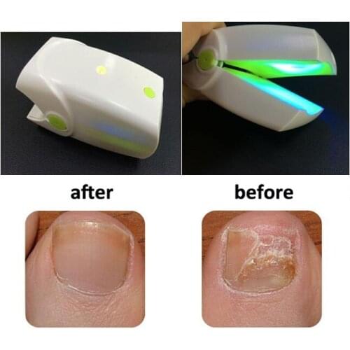 Mini Toenail Onychomycosis Therapy Cure Equipment Ex Nail Fungus Treatment Laser Device Cleaning Safe Toe Finger Fungal Remover