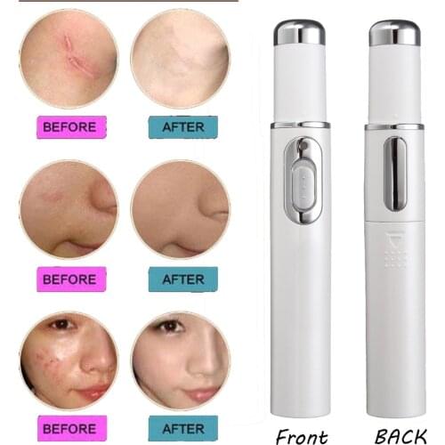 Blue Light Therapy Pen for Varicose Veins Therapy Wrinkle Acne Laser Pen Pen for Varicose Veins Health Care Beauty Products