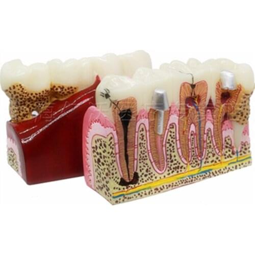 Dental Tooth Teeth Anatomical Model Dental Anatomy Teeth Model Oversized Anatomy