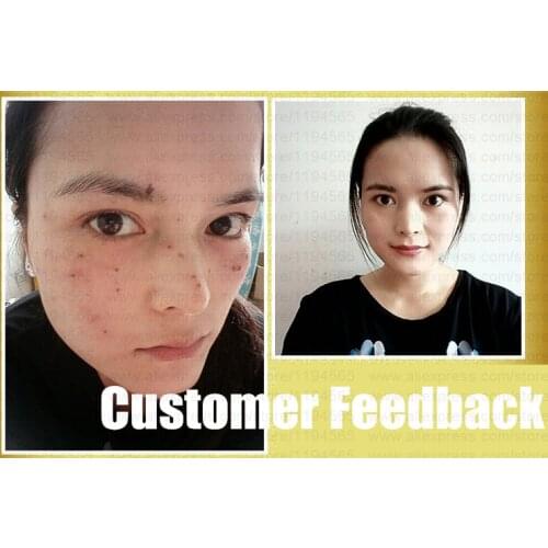 2pcs Set Speckles Moles Warts Removal Black Spots Splashes Remover Free Shipping