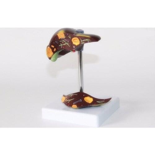 Liver model liver pathology model fatty liver cirrhosis liver carcinoma model hepatobiliary disease model free shipping