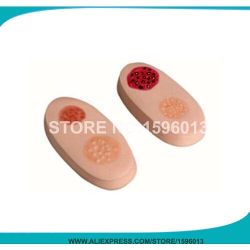 Vivid Variola Lesion Modules, Smallpox Simulator Skin Model,Variola Pathological Changes Nursing Model