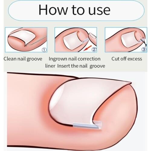 10pcs/set Ingrown Toenail Correcting Tool Pain Care Ingrowing Nail Corrector