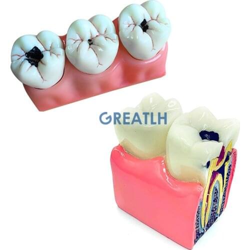 4:1 Size Dental Caries Removable Teeth Tooth Model Learn Study Model