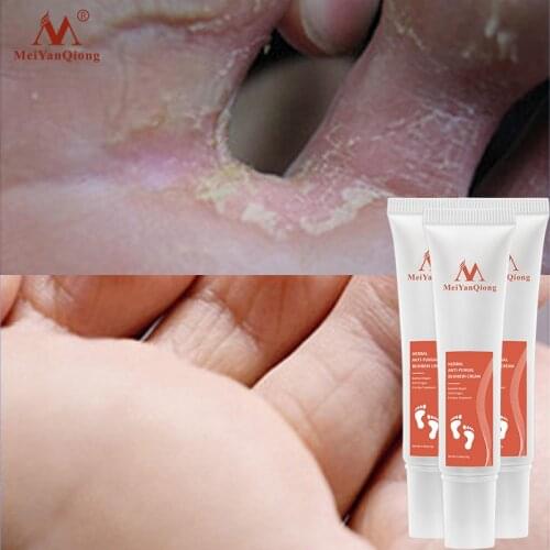 3PCS Herbal Foot Treatment Anti Fungal Infection Onychomycosis Paronychia Toe Fungus Treatment Removal Dead Skin Hand Feet Care