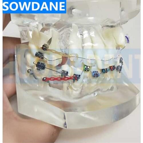 Transparent Dental Orthodontic Mallocclusion Model with Mental Ceramic Brackets Archwire buccal tube for Patient Communication