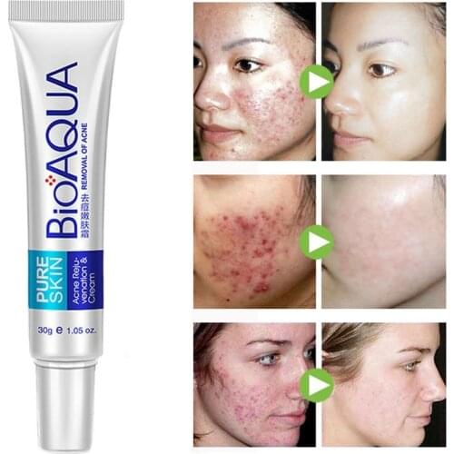 BIOAQUA Anti Acne Face Cream Facial Serum Mask Acne Treatment Oil Control Shrink Pores Moisturizing Whitening Skin Care