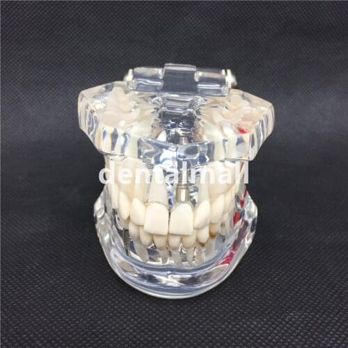 Dental Implant Disease Teeth Model With Restoration Bridge Tooth Dentist For teaching