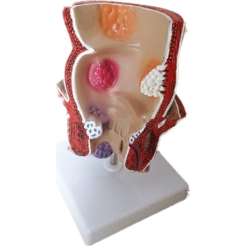 Human rectal pathology model drug promotion shows the gift model intestinal digestive system teaching model